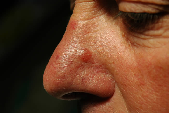 Basal Cell Carcinoma