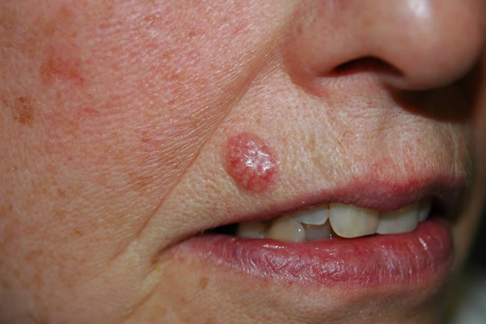 Basal Cell Carcinoma