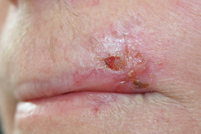 Basal Cell Carcinoma