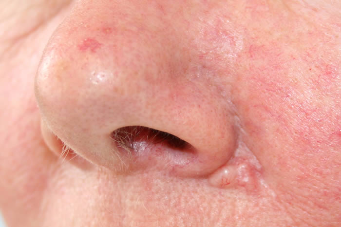 Basal Cell On Nose