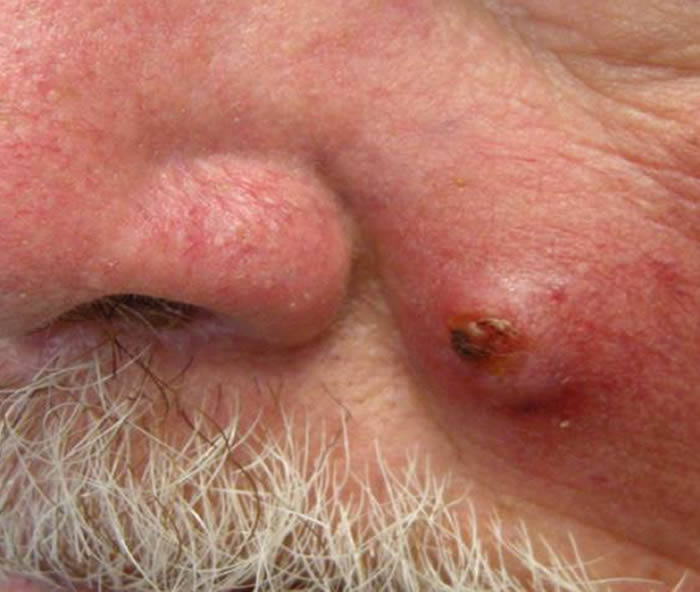 Squamous Cell Carcinoma