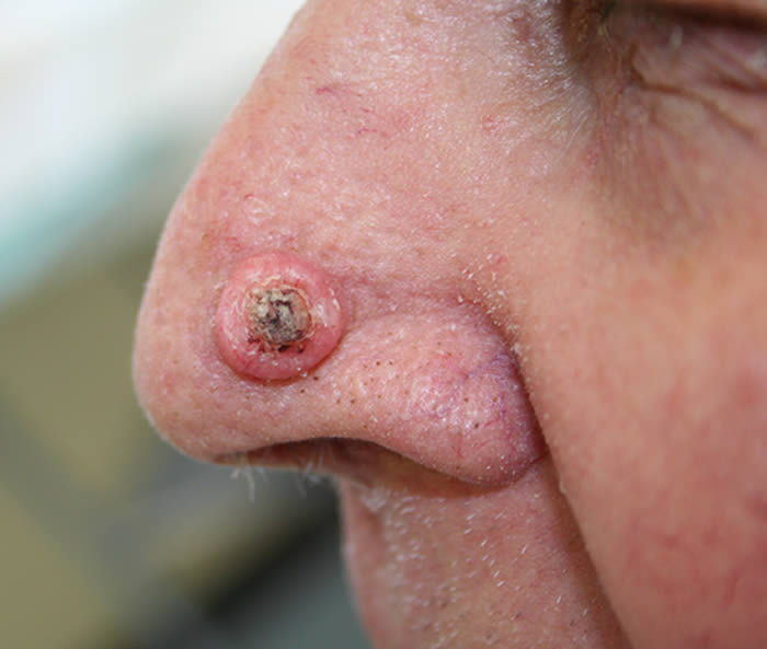 Squamous Cell Carcinoma