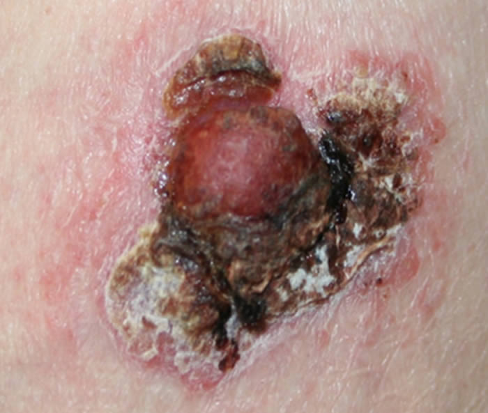 Squamous Cell Carcinoma