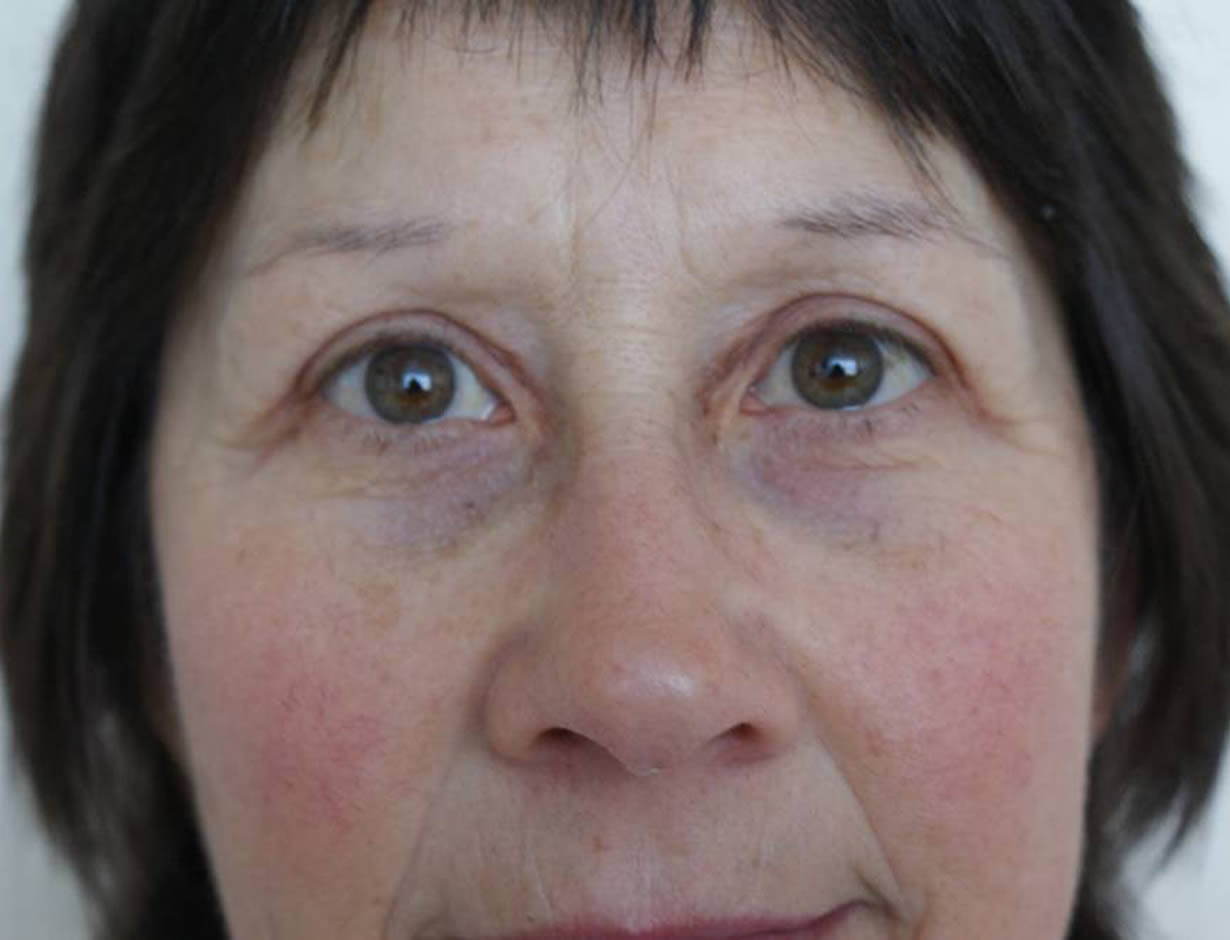 After Blepharoplasty