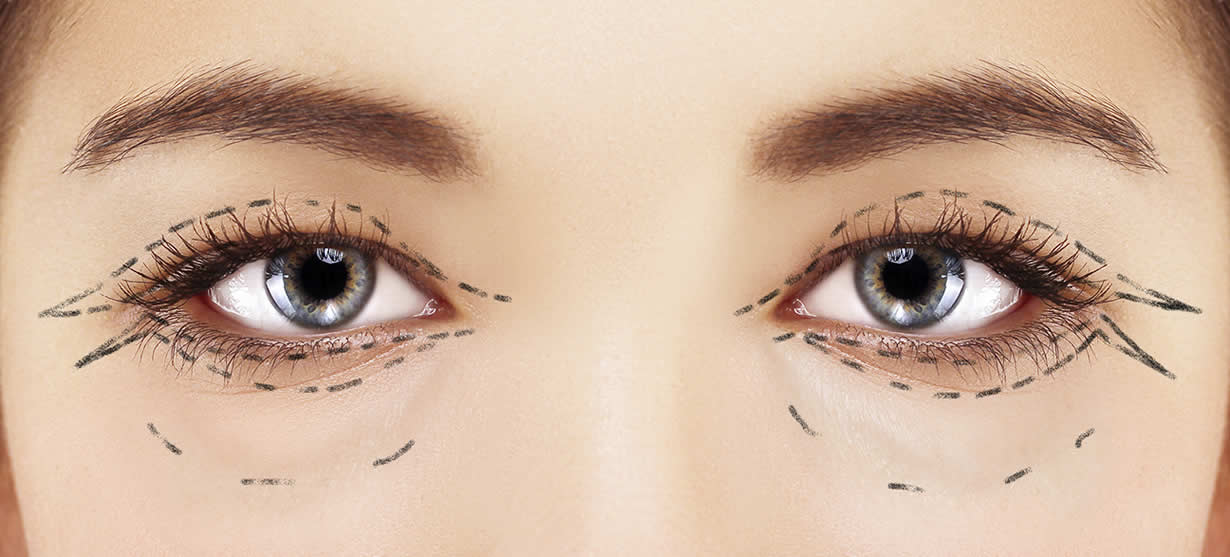 Blepharoplasty