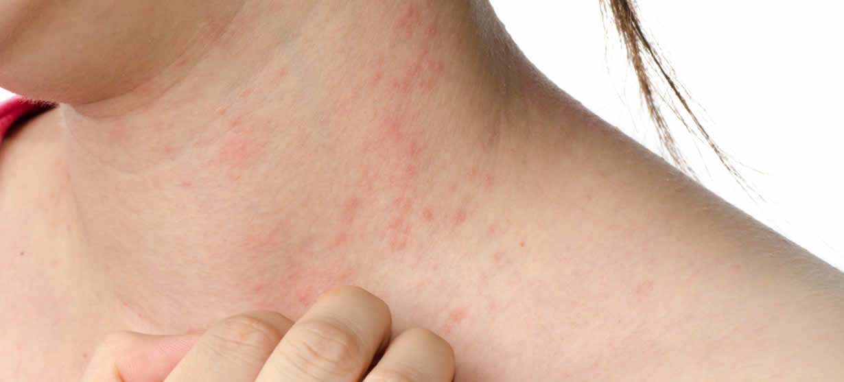 rash treatment | eczema treatment