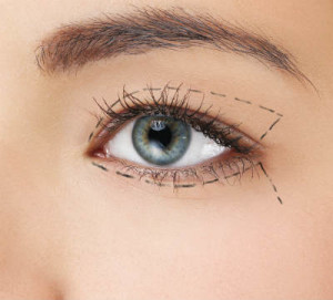 eyelid surgery